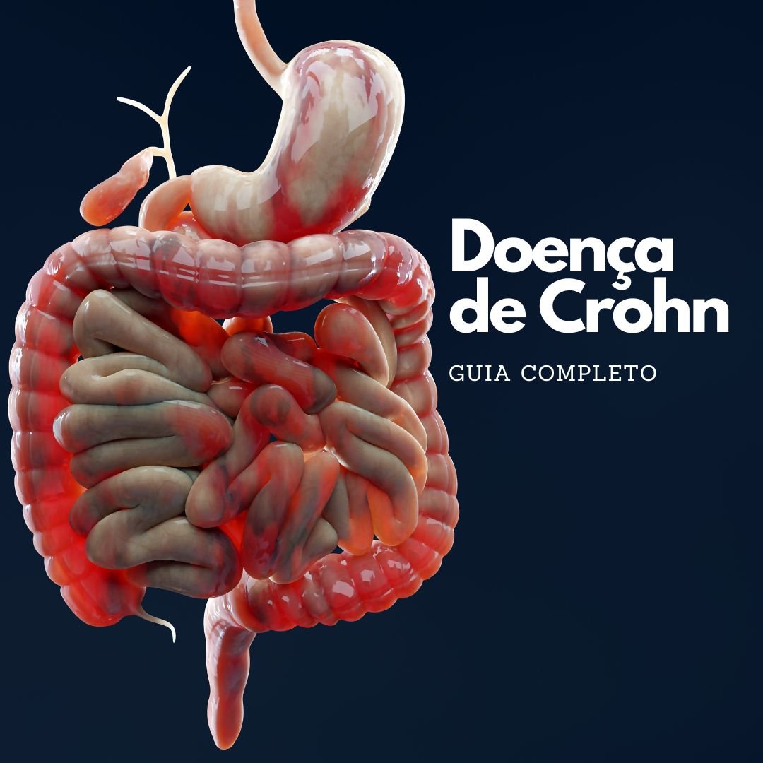 Doença De Crohn Guia De Sintomas E Tratamentos Eficientes 