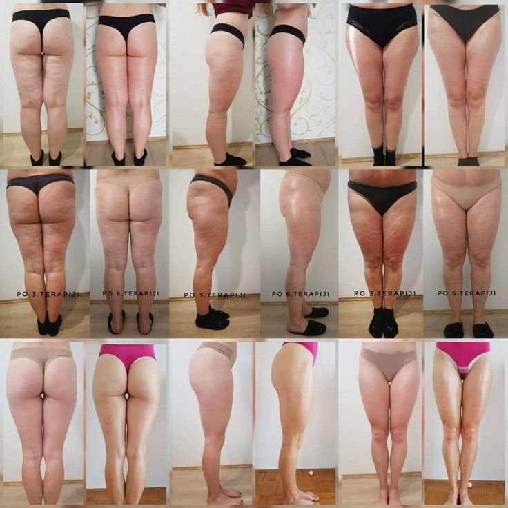 Resultados e melhorias do Lipedema