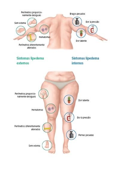 Sintomas do Lipedema